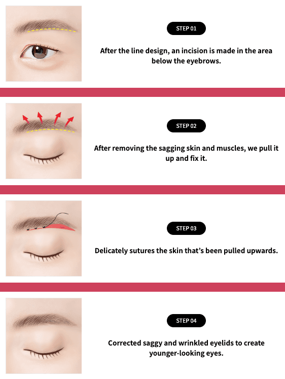 Eyebrow Lift