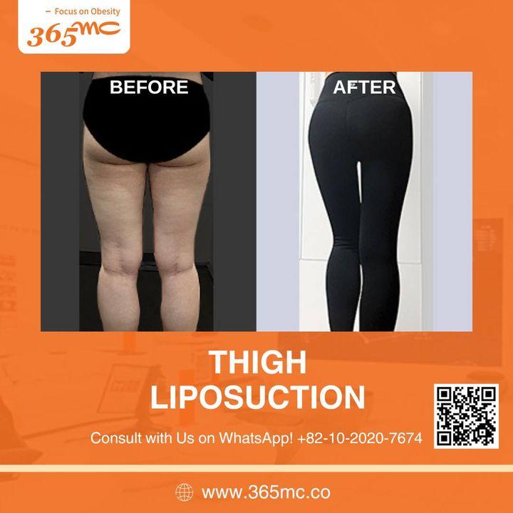 Achieve your desired body contours with thigh liposuction at 365mc. Our before and after photos reveal the dramatic changes and confidence our patients gain.