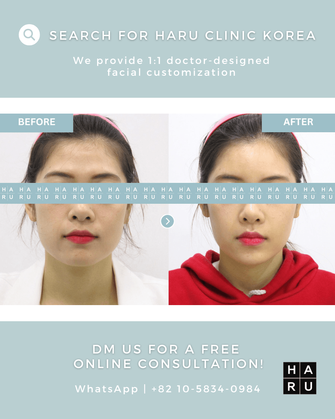 Face Thread Lift, Lip Fillers, Nose Filler, Facial Filler, Smile Line Filler, Forehead Filler, Under Eye Filler