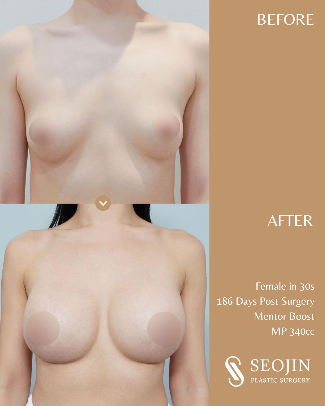 seojin-breast-implant-5 