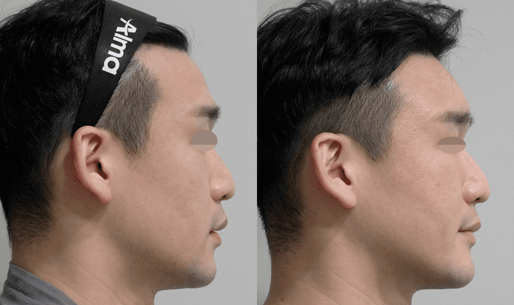 Before and After Stem Cell Facial