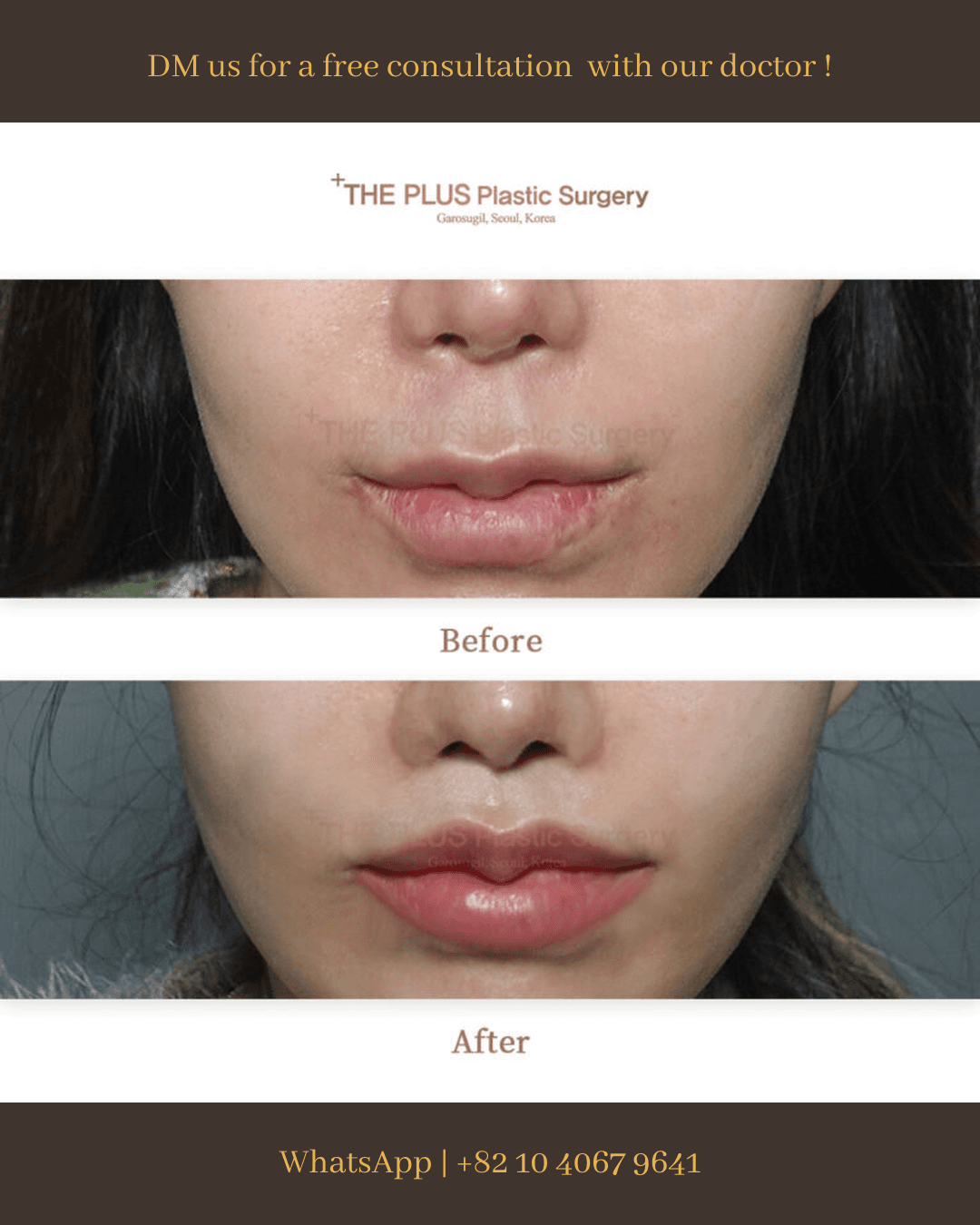 Lip Augmentation, Bullhorn-Lip-Lift, Philtrum Reduction Surgery