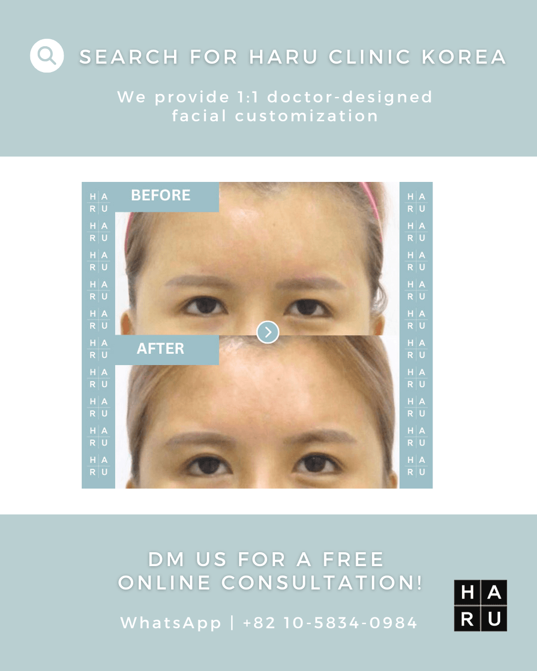 Forehead Thread Lift, Eye Thread Lift