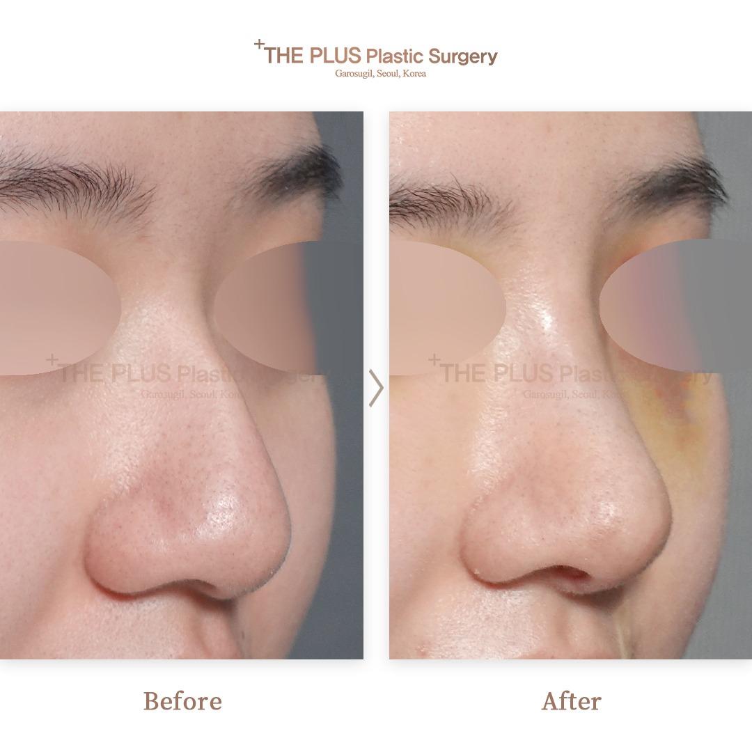 Rhinoplasty & Hump Correction & 3D Implant