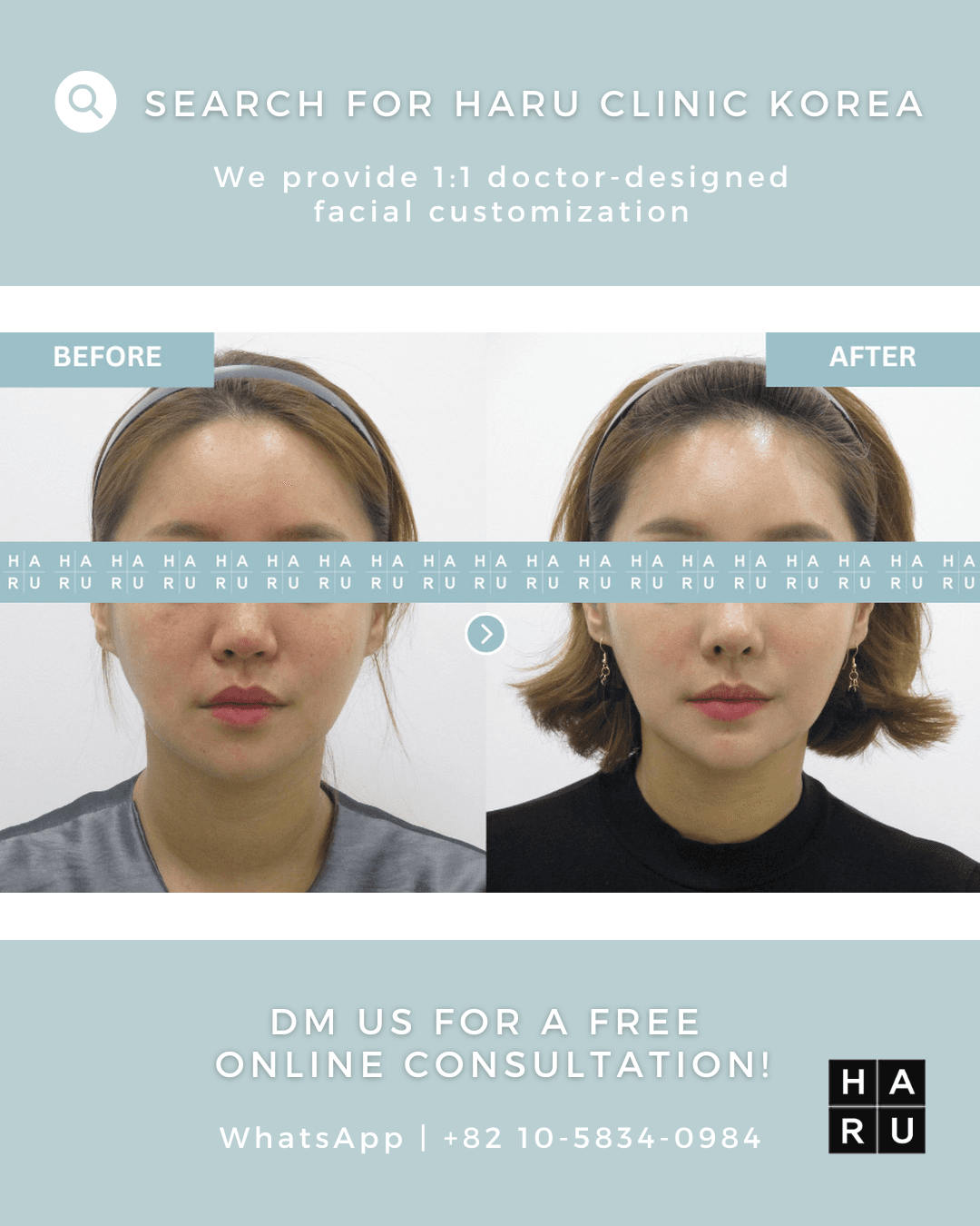 Kinnfiller, Kinn-Botox, fettauflösende Injektion