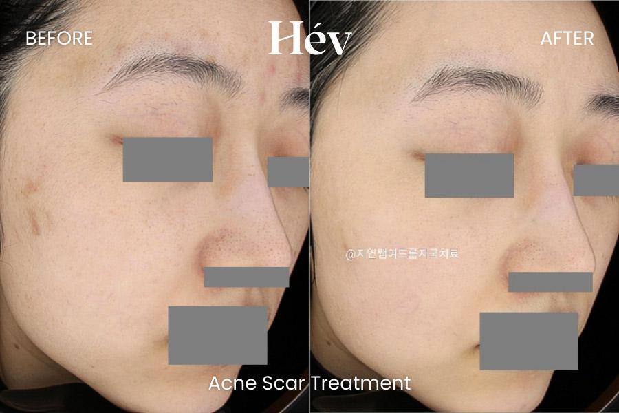 Acne Scar Treatment