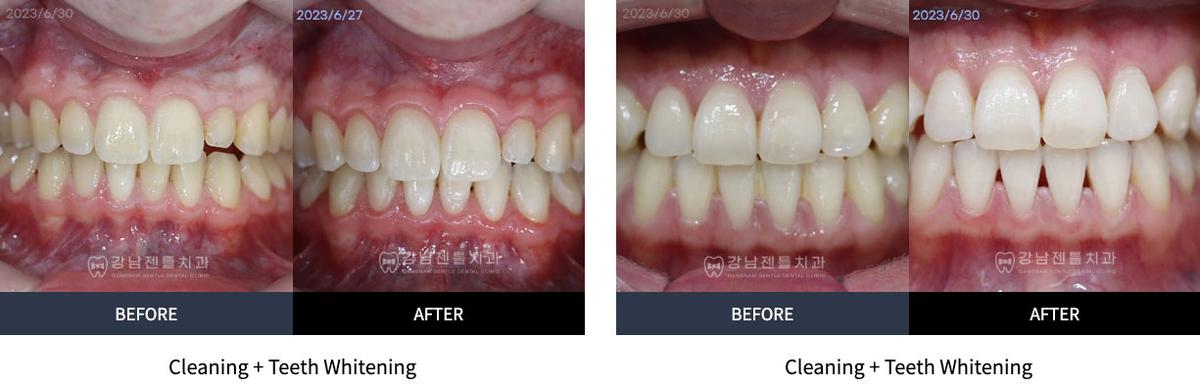 Before and After Teeth Cleaning