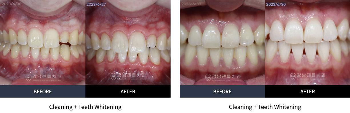 Teeth Cleaning and whitening before and after