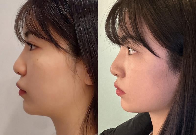Female nose thread lift 1 week