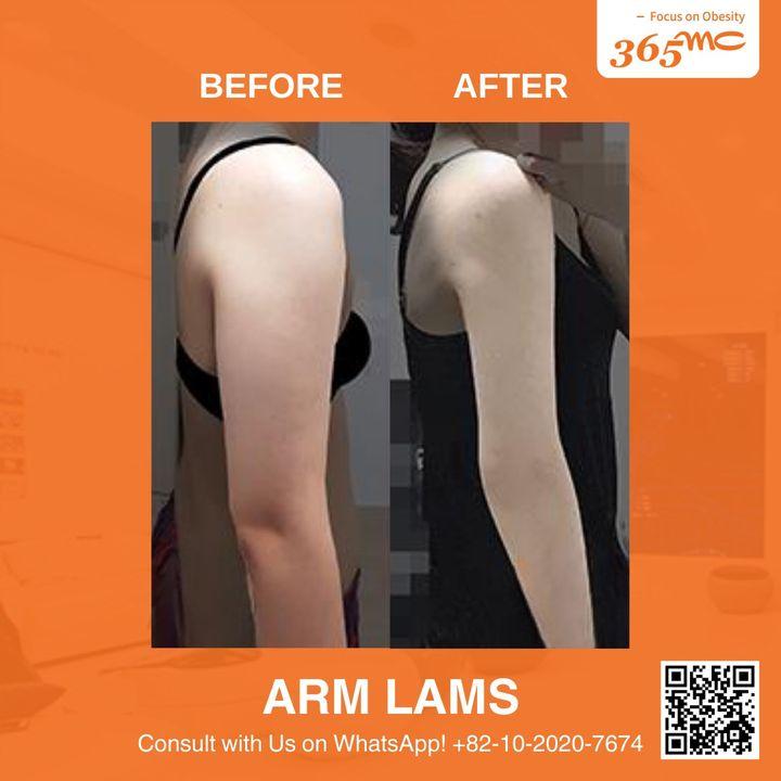 Reveal the refined contours of your arms with our ARM LAMS procedure. Gentle, yet effective, this minimal-invasive technique is designed for your comfort and confidence.