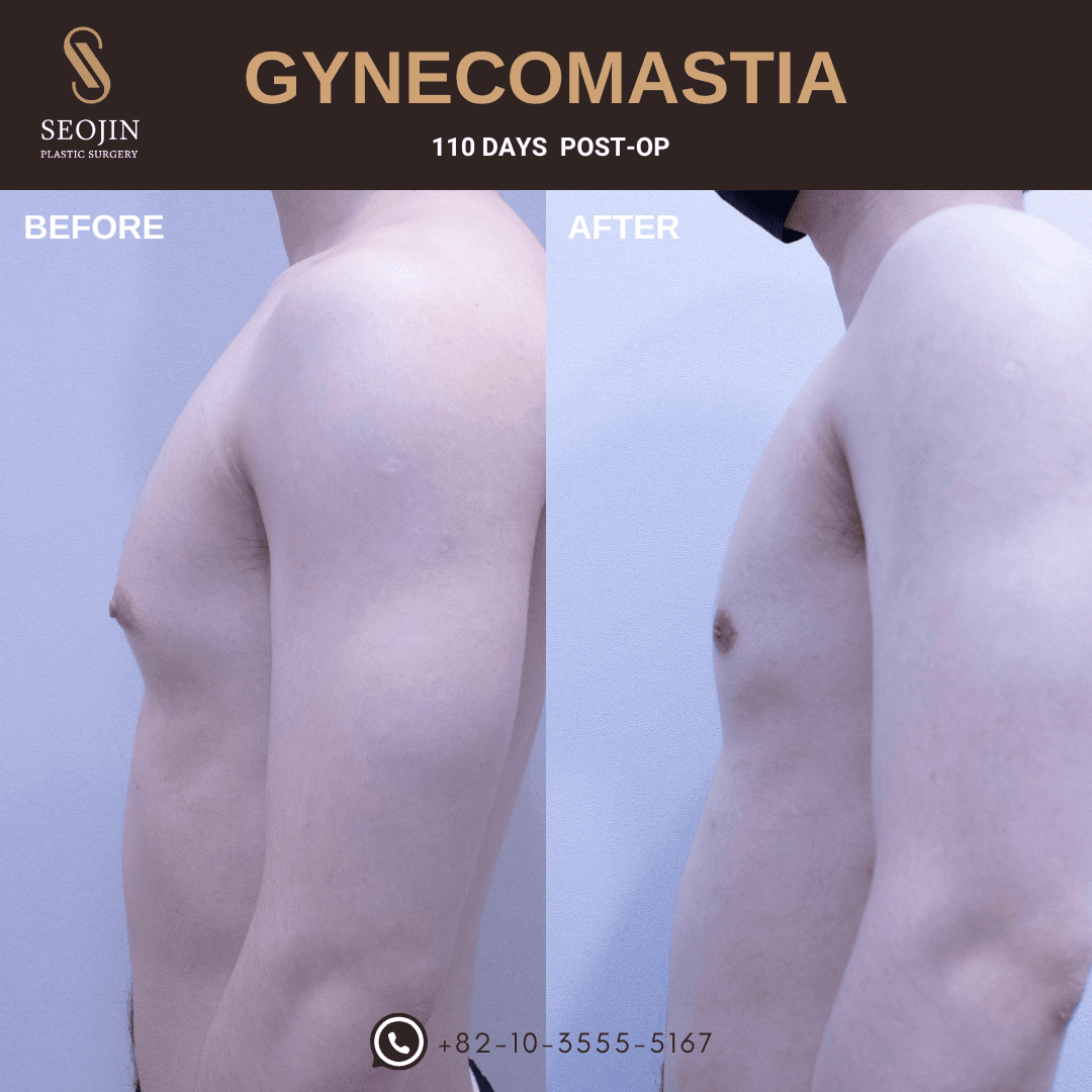 remove male breasts korea