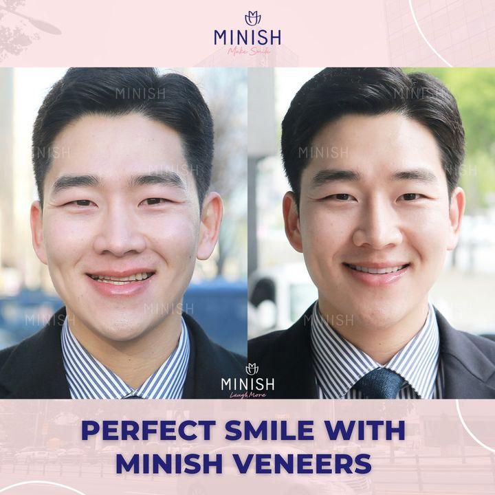 cost veneers korea