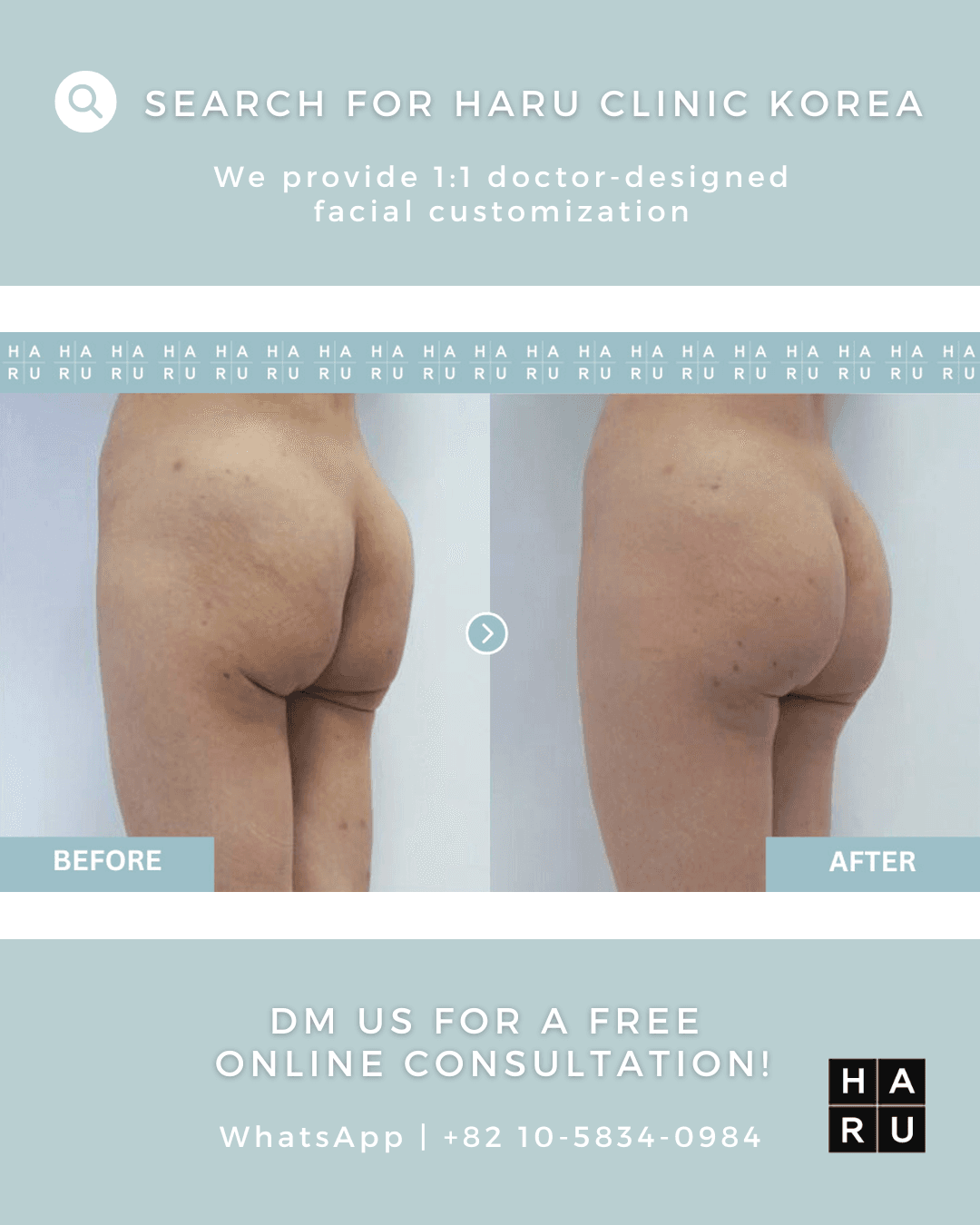 Butt Thread Lift
