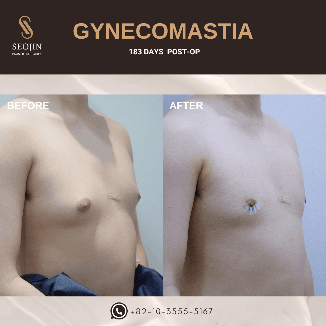 cost gynecomastia korea
