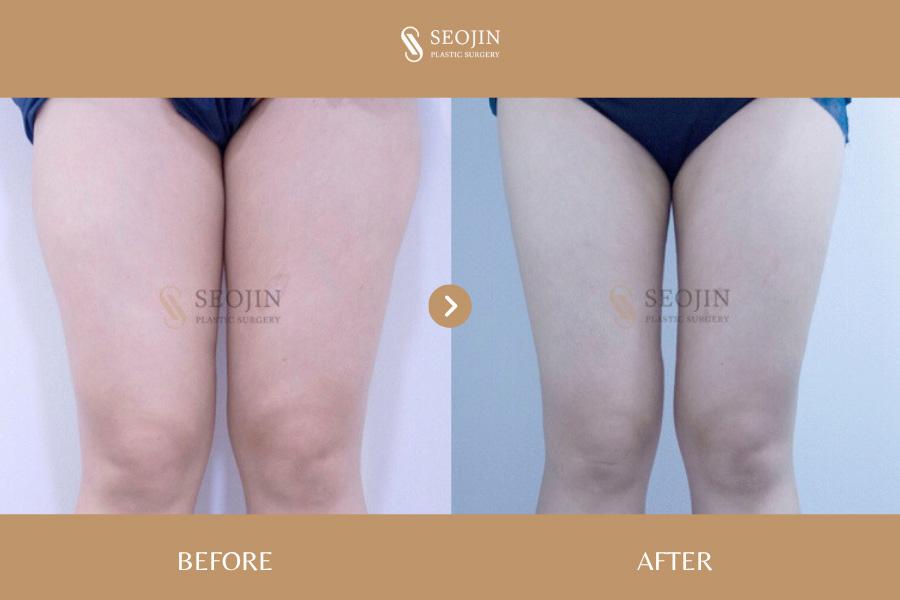 Before and After Thigh Liposuction
