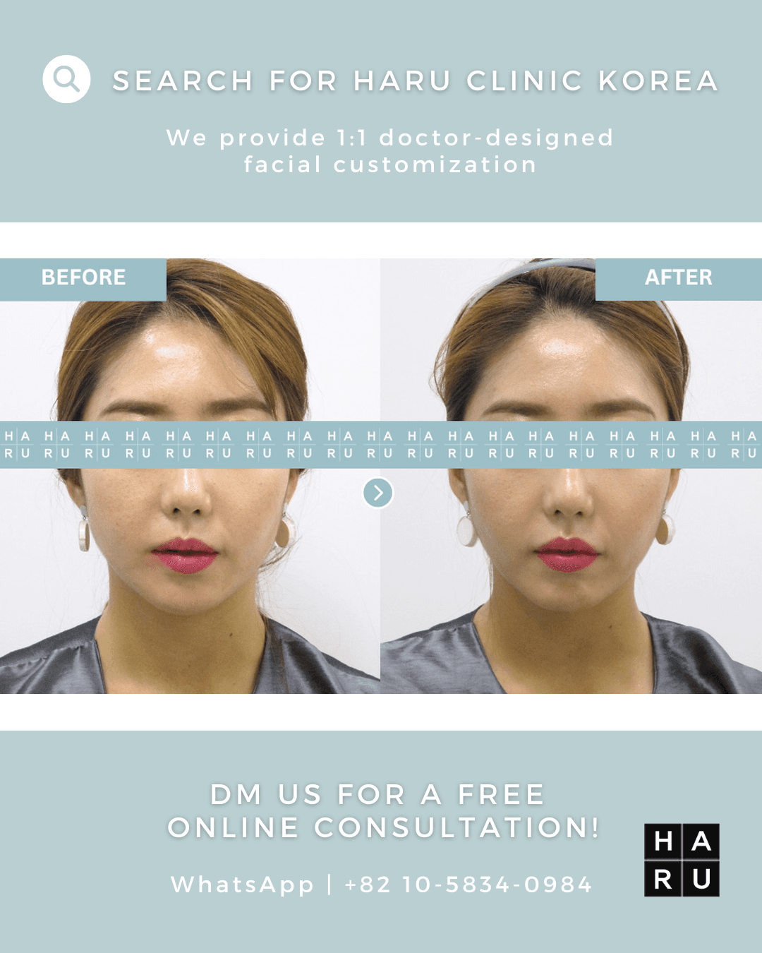Lip Fillers, Mouth Corner Lift Botox