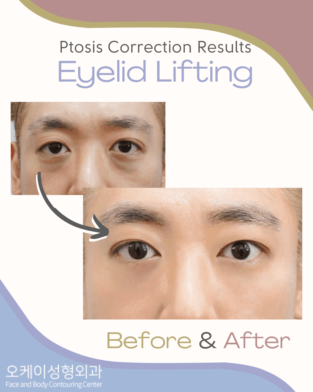 alleviate forehead wrinkles caused by lifting eyebrows korea