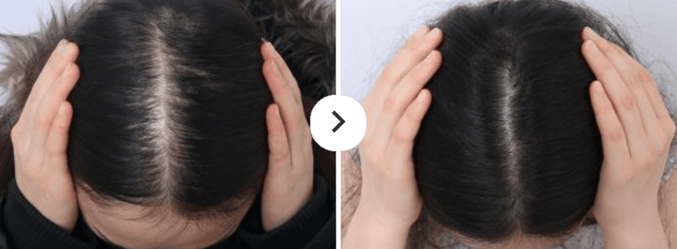Before and After Hair Loss Treatment