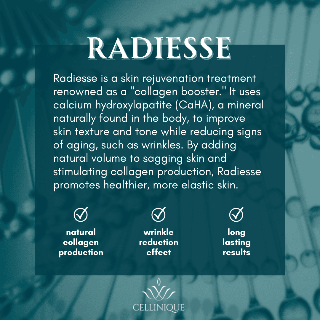 Radiesse Filler