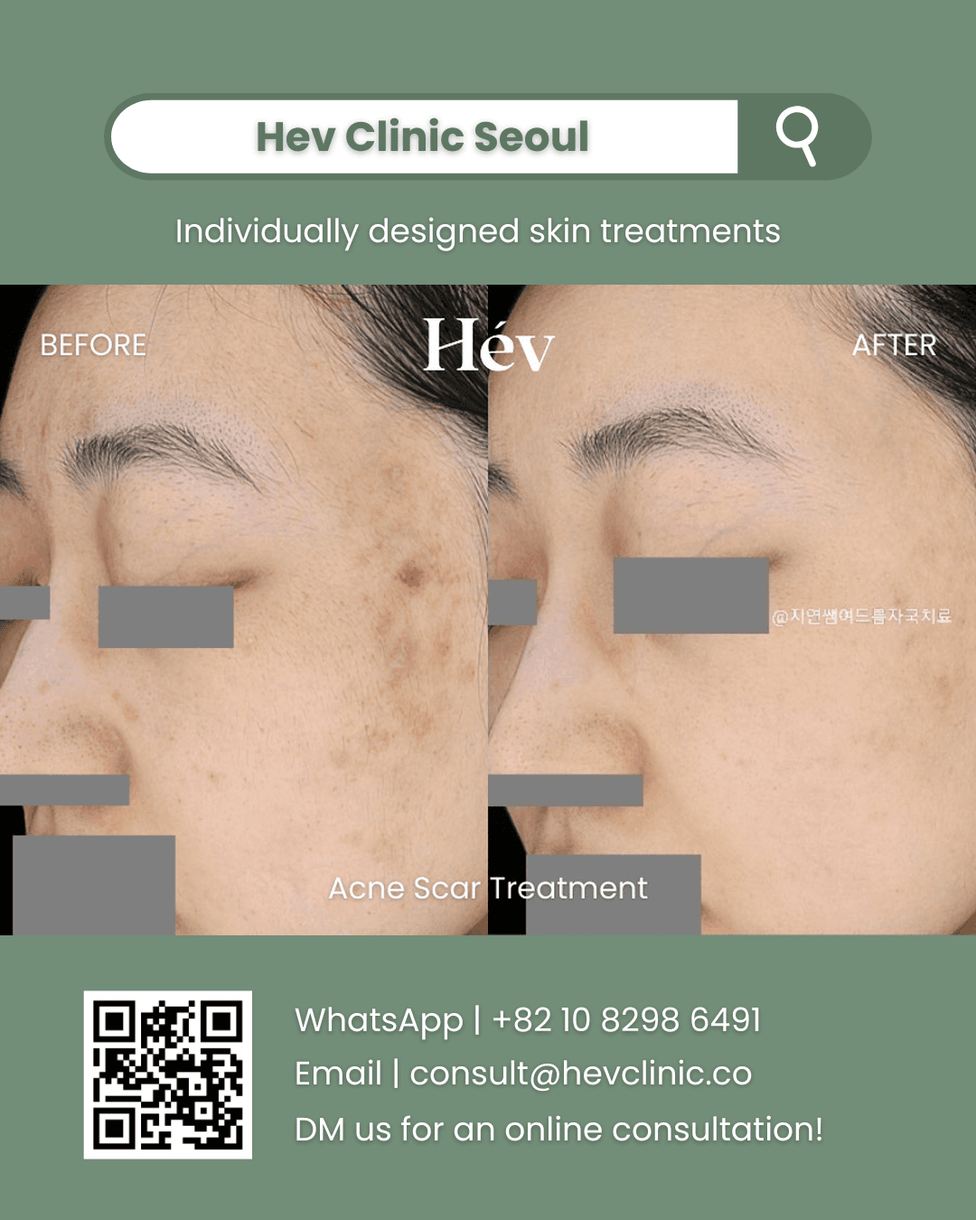 Acne Scar Treatment, Acne Treatment