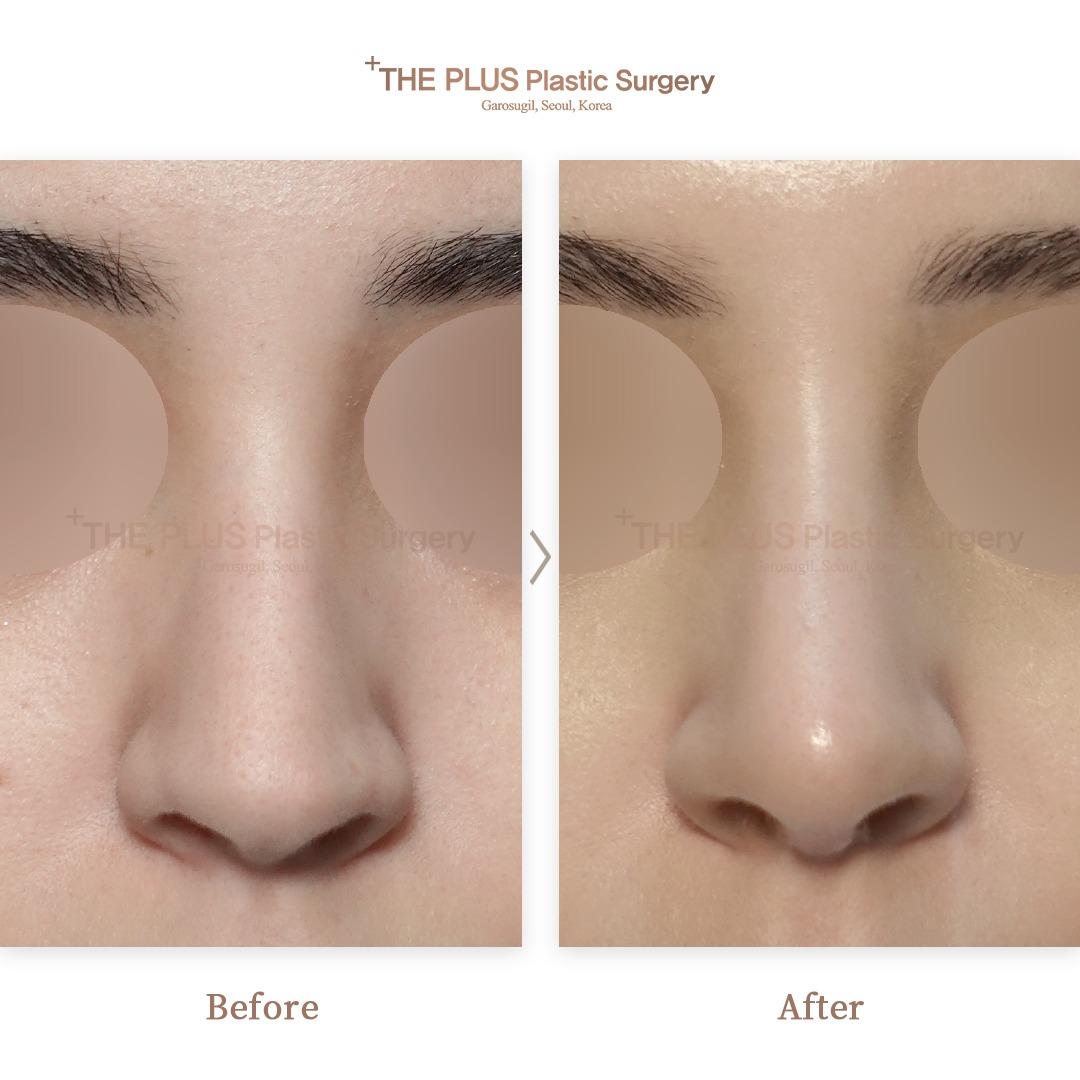 THEPLUS Plastic Surgery before and after image