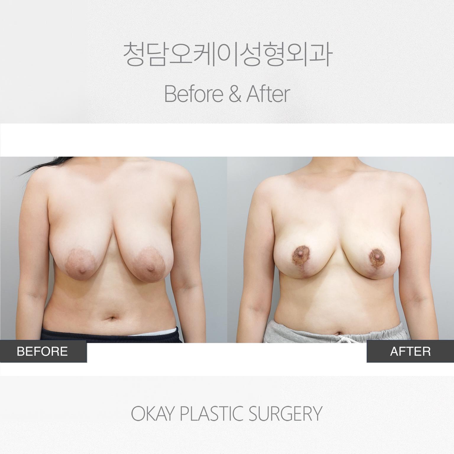 Breast Lift with Areolar Incision Method