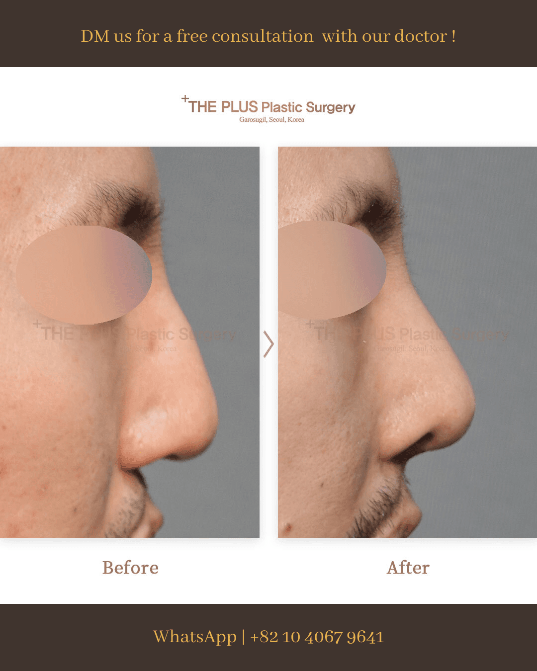 Cleft Lip Surgery, Cleft Rhinoplasty, Cheiloplasty, Cleft Palate Surgery
