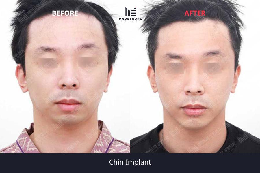 Implant 1