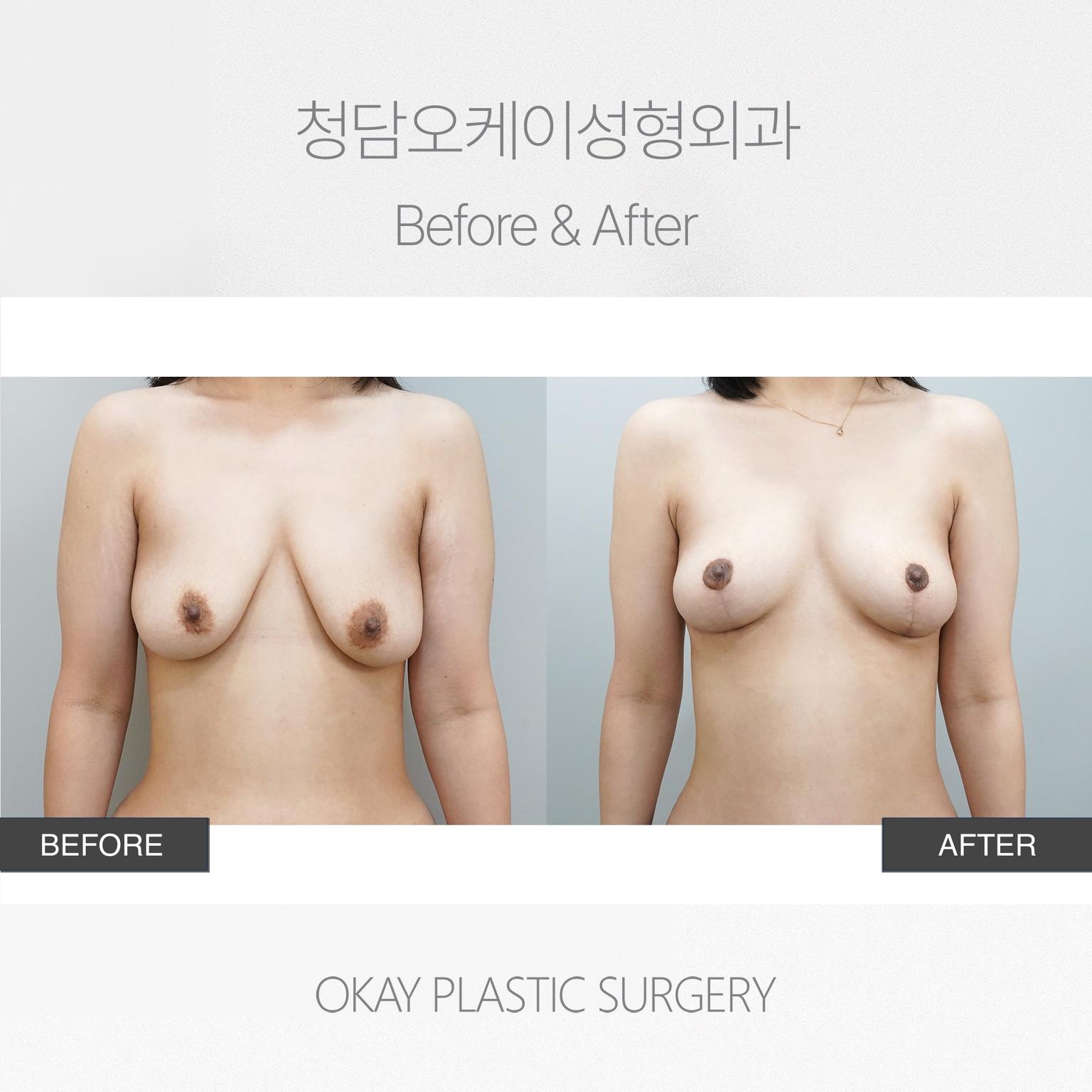 Breast Lift with Areolar Incision Method