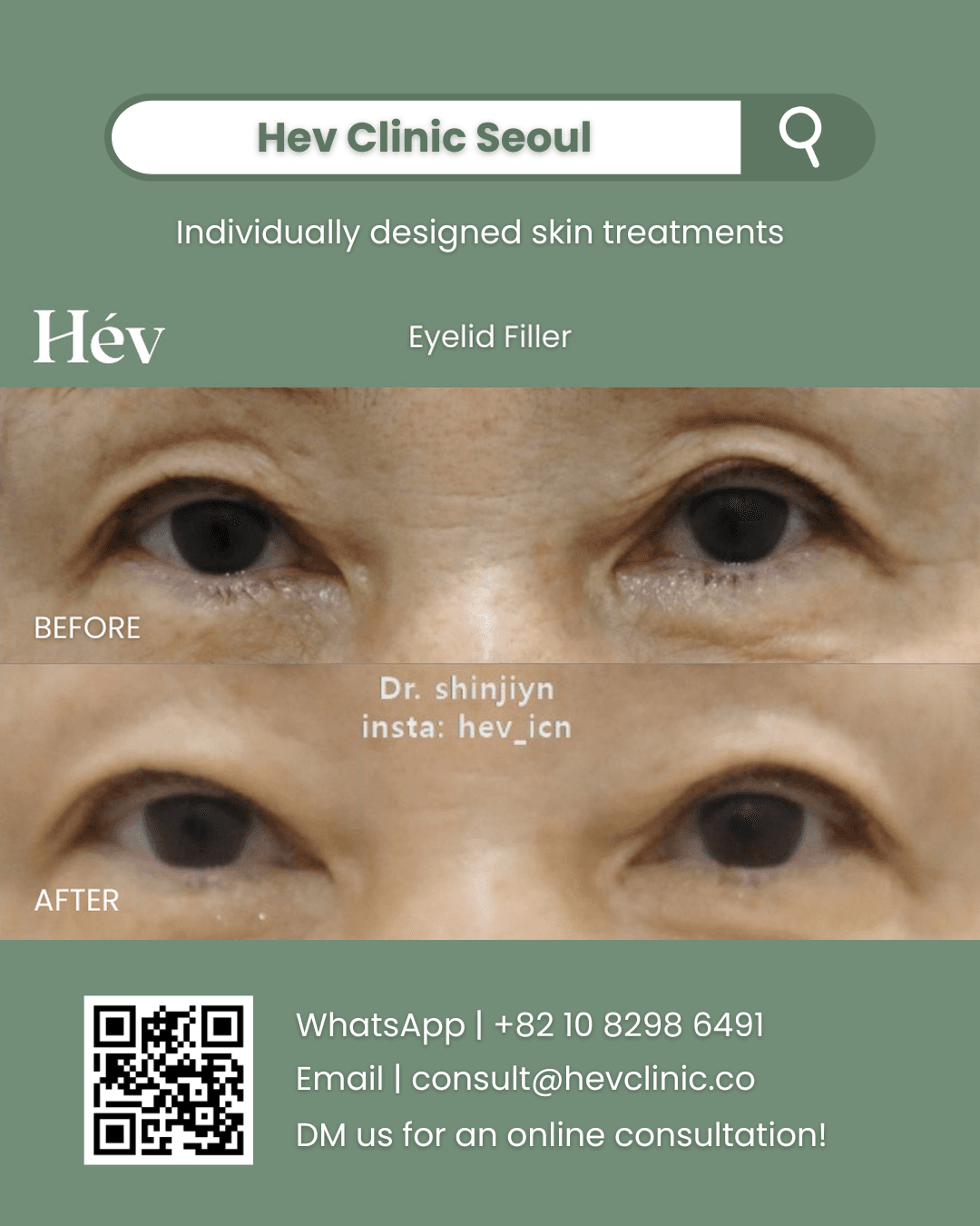 Eyelid Filler