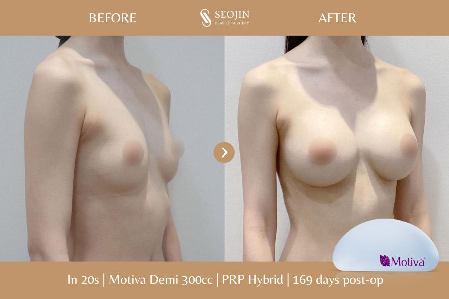 Seojin Plastic Surgery Clinic before and after image
