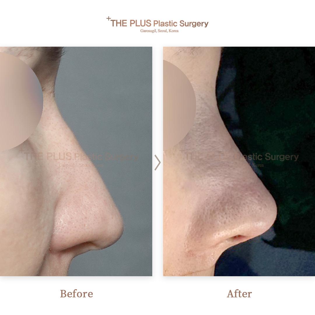 2. Revisionsrhinoplastik & Nasenosteotomie & Korrektur der Nasenscheidewand & Rhinitis