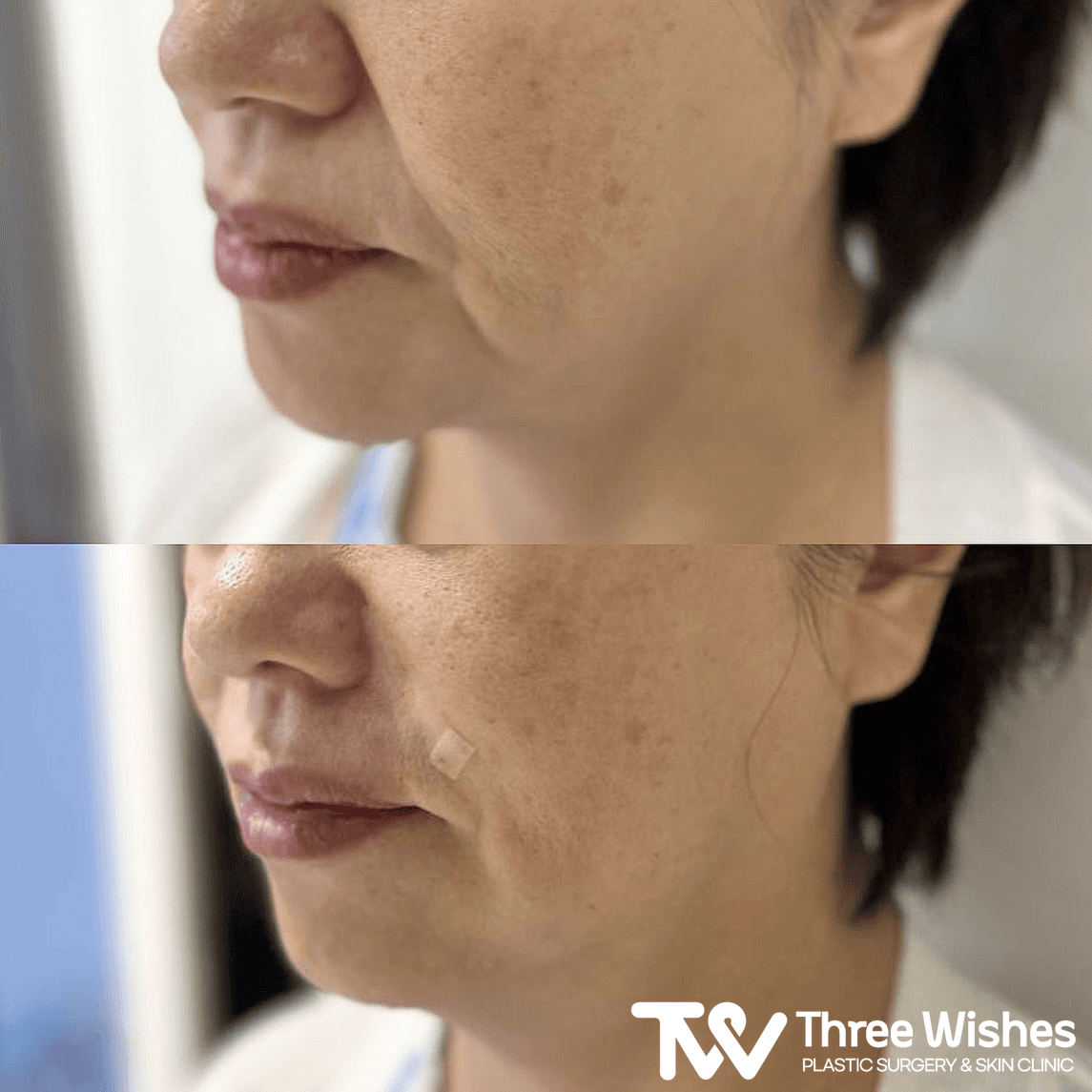 Before and After Smile Line Filler