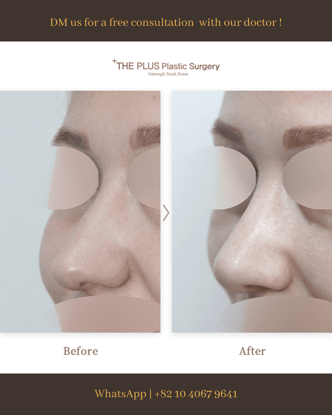 Rhinoplasty, Rhinitis Surgery