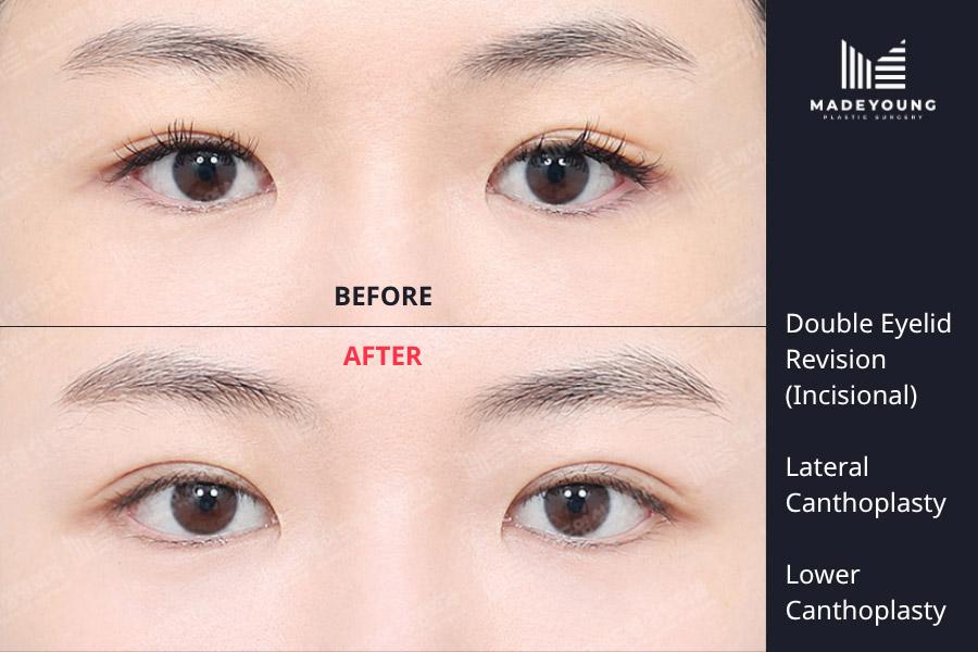 Eyelid revision incisional lateral canthoplasty lower canthoplasty