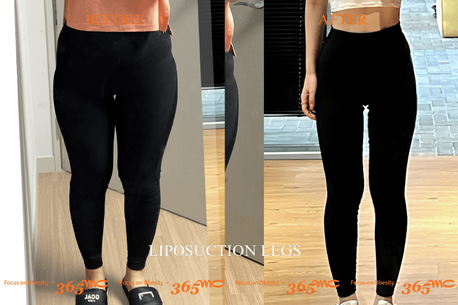 Before and After Thigh Liposuction