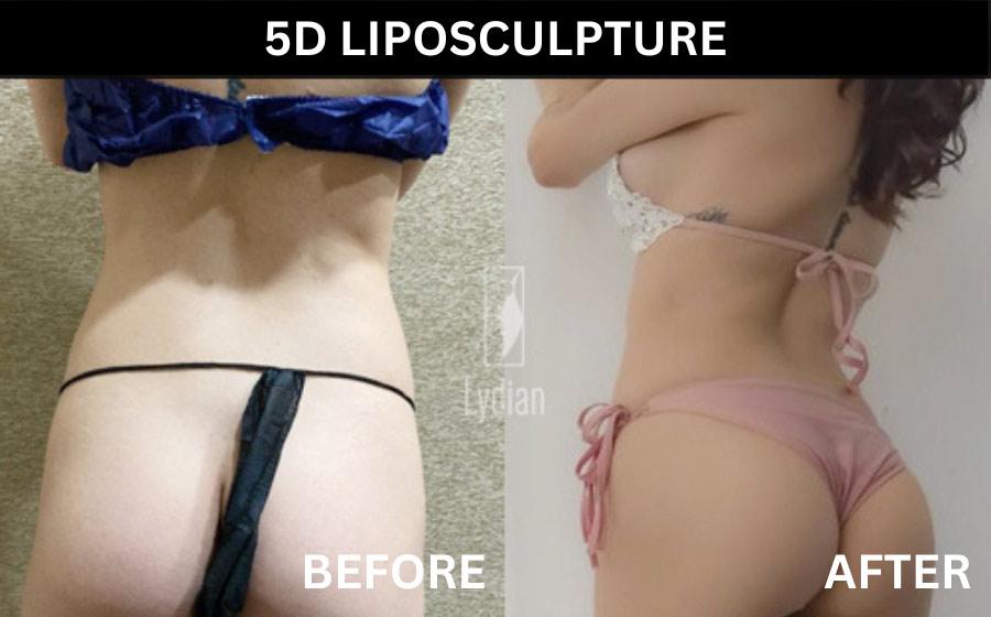 5d liposculpture korea