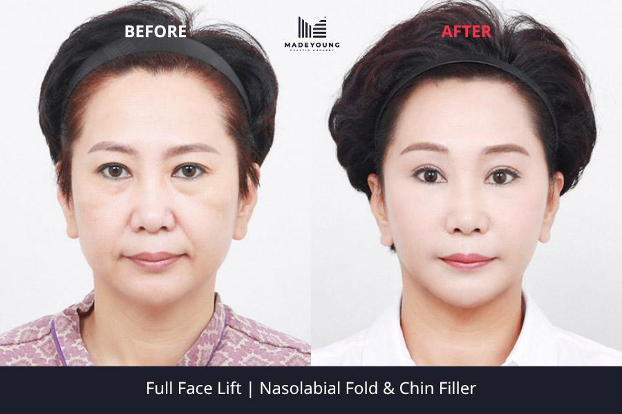 Before and After Face Lift