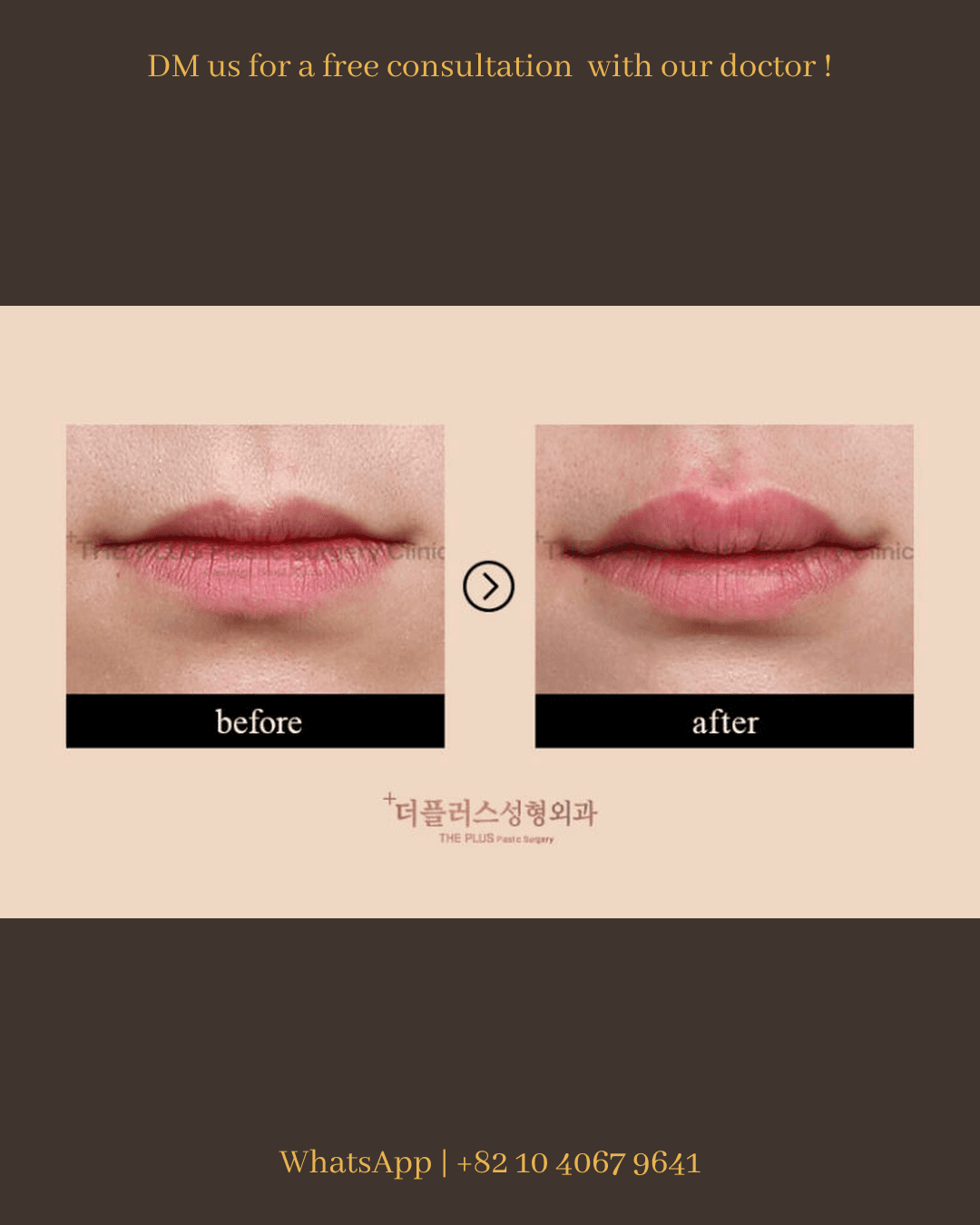 Lip Fillers, Lip Plastic Surgery