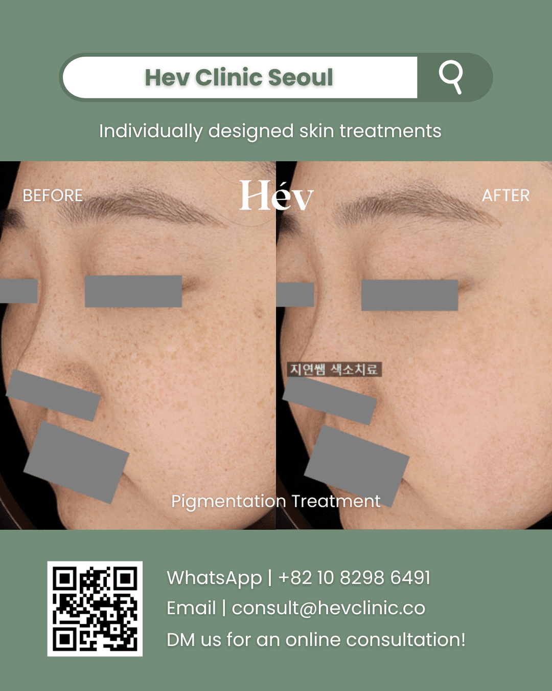 Pigmentation Treatment