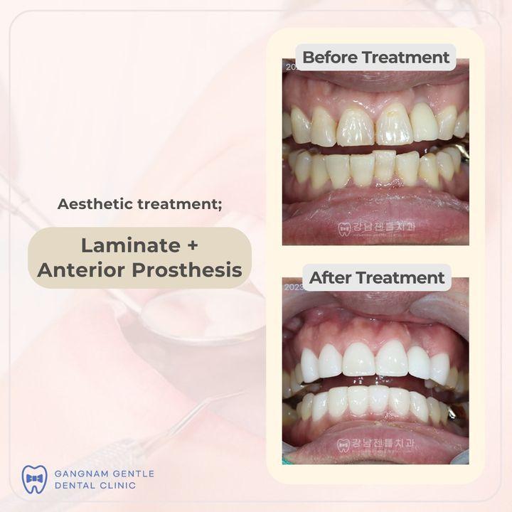 Discover the perfect blend of artistry and innovation with our advanced laminate and anterior prosthesis solutions. Let us craft a smile that not only looks stunning but also feels comfortable and natural.