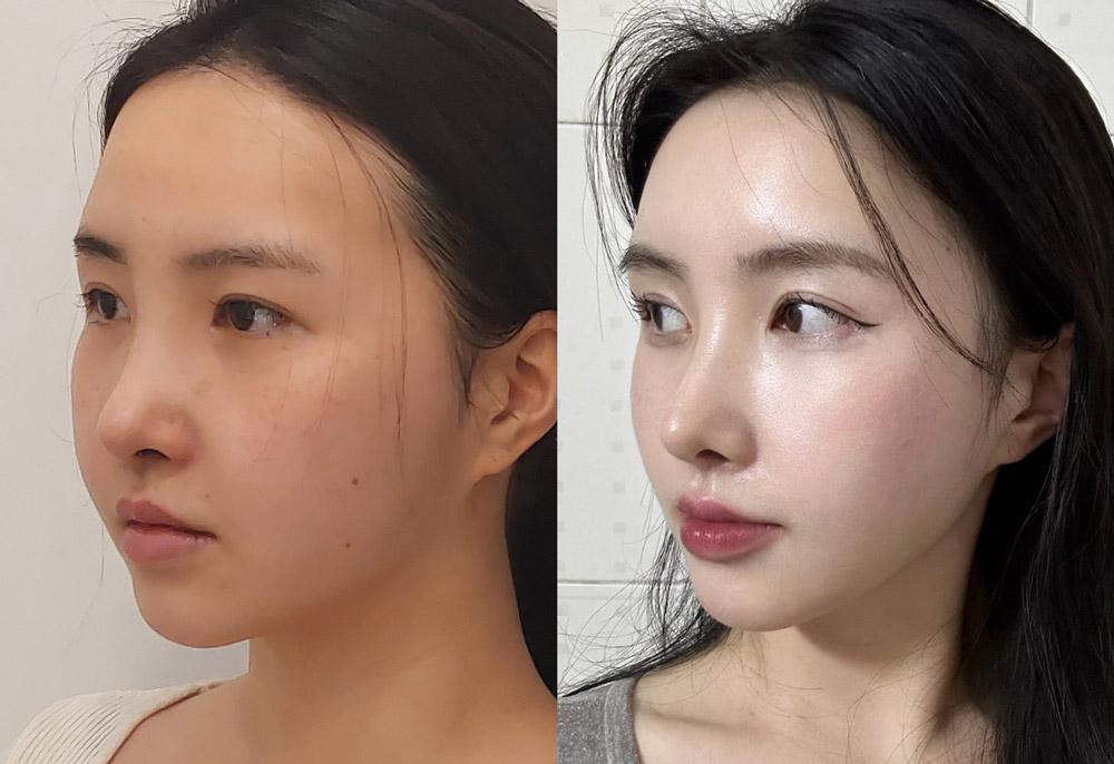 Female forehead eyebrow thread lift 2 month