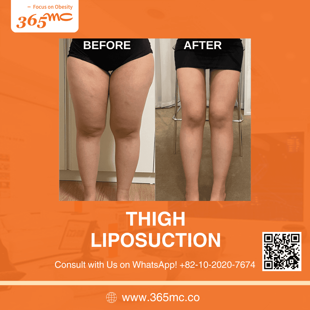 bna-thigh-iiposuction-02.png