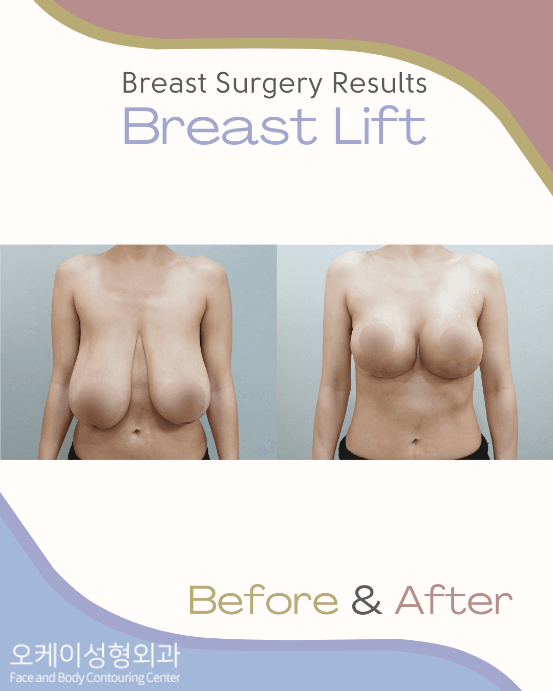 cost breast lift korea