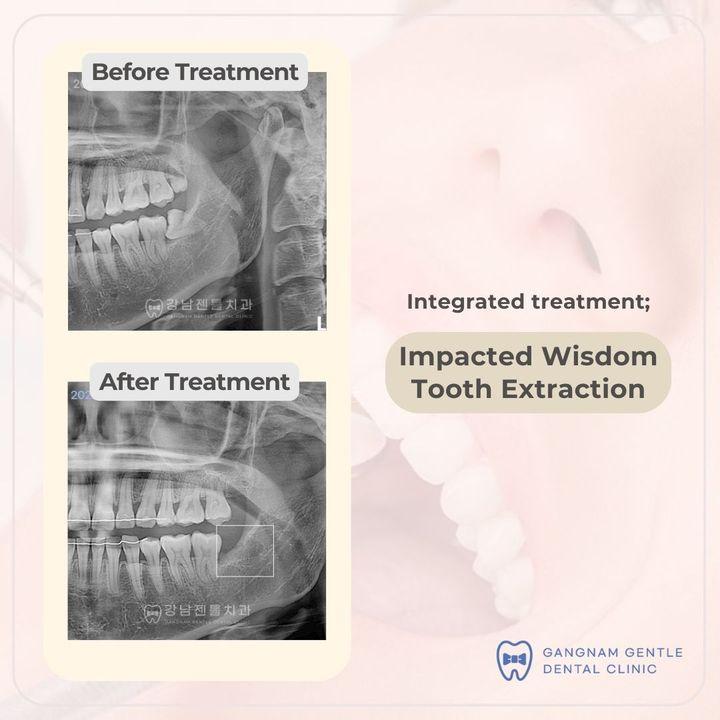 Before & After Impacted Wisdom Tooth Extraction. Say Goodbye to Discomfort, Hello to Relief!