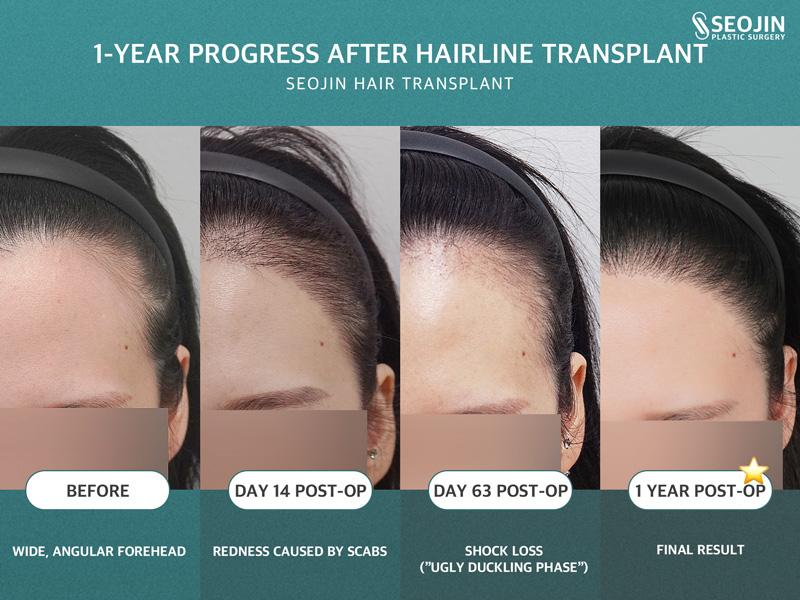 Seojin Plastic Surgery Clinic before and after image