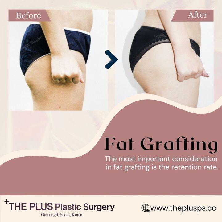 Understanding Fat Grafting for Butt Enhancement at ThePlus! 🍑✨ Discover the transformative approach of using your body's own fat to sculpt and shape a fuller, natural buttock. Unlike implants, fat grafting offers a more organic result, blending seamlessly with your body. Curious about the process? Let's delve into the science of enhancing your curves naturally!   ►