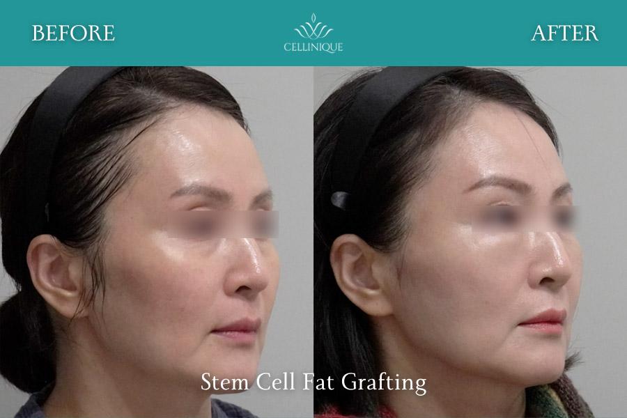 Before and After Stem Cell Fat Grafting