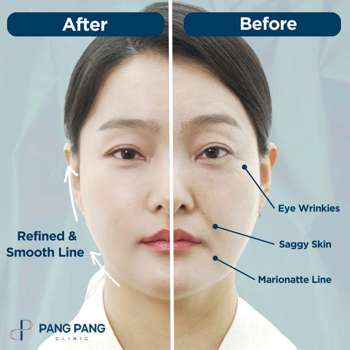 Thread Lift, Face Thread Lift