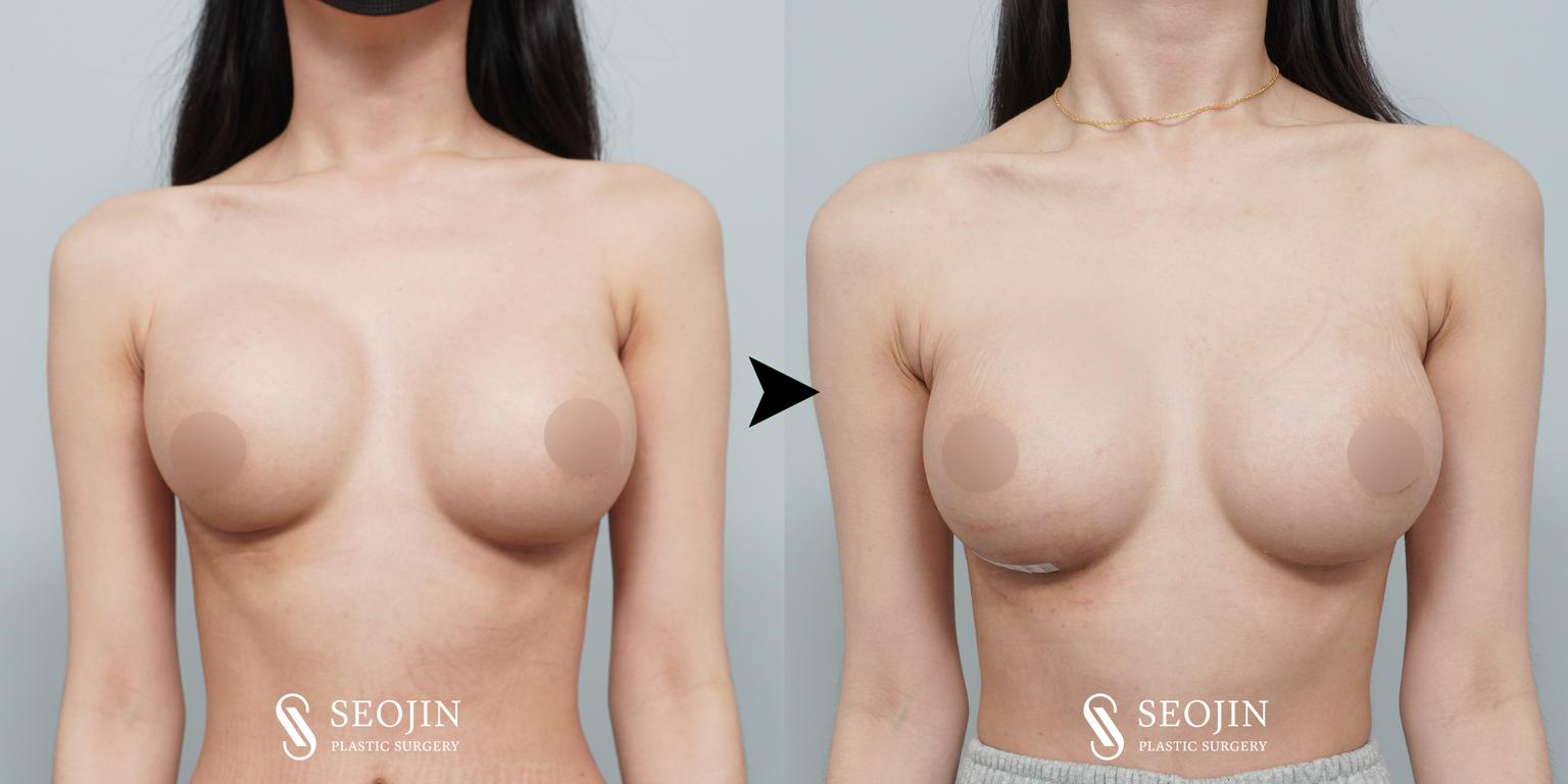 Seojin Plastic Surgery Clinic before and after image